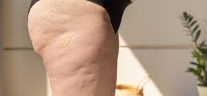 Does Cellulite Treatment Work on All Skin Types?