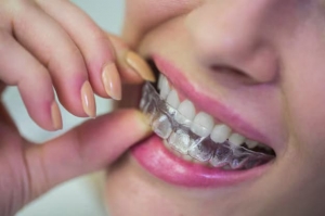 The Benefits of Using Clear Aligners for a Straighter Smile