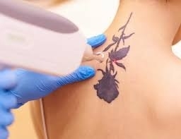 Tattoo Removal Treatment in Indore – Safe, Effective & Advanced Laser Solutions