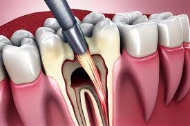Common Myths and Facts About Root Canal Therapy