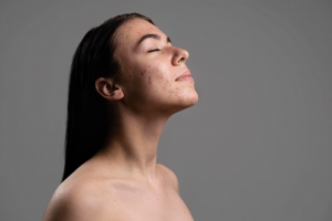 Your Guide to Acne Treatments in Birmingham