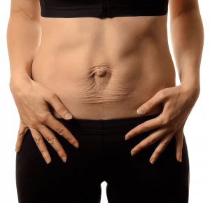 Can tummy tuck help repair abdominal muscle separation?