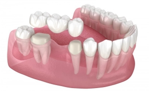 Exploring Dental Crowns & Bridges in Parramatta: What You Need to Know