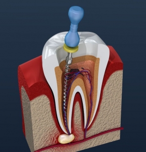 Understanding Root Canal Treatment in Hinjewadi: Your Guide to Pain-Free Dental Care