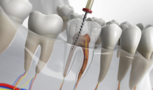 10 Things to Know Before Root Canal Treatment in Dubai