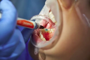 Everything to Know About Dental Fillings in Ventura Clinics