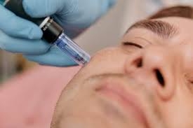 Microneedling San Antonio: Treat Hyperpigmentation for Even Skin Tone