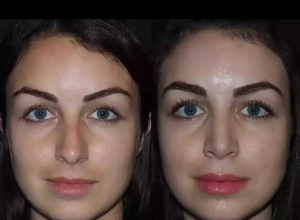 Septoplasty in Dubai: Is It the Answer to Breathing Problems?