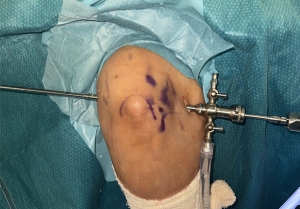 Arthroscopy of the Elbow: A Complete Guide to Minimally Invasive Joint Care