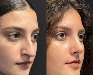 Rhinoplasty in Dubai: Can It Truly Redefine Your Look?