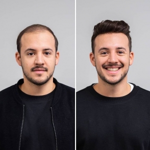 Non-Surgical vs. Surgical Hair Options in Riyadh: Key Differences