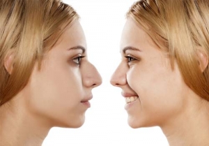 Your Step-by-Step Journey Through Rhinoplasty Cosmetic Surgery with Professionals