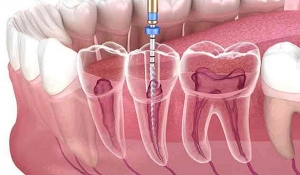 Hidden Costs of Root Canal Treatment: What Patients Should Know