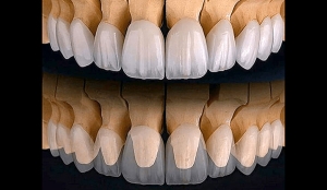 How Strong Are Zirconia Crowns Compared to Others?