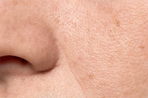 What Determines Large Pores Treatment Cost in Dubai?