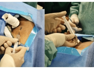 Varicocele Surgery Cost in Pune: Factors You Should Know