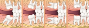 Close-up X-ray of impacted wisdom teeth before surgical intervention — highlighting wisdom tooth removal and wisdom teeth extractions performed by experts in Adelaide.