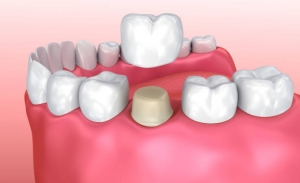 Are Porcelain Crowns Good for the Long-Term?