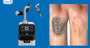 Everything You Need to Know About a Laser Tattoo Removal Machine