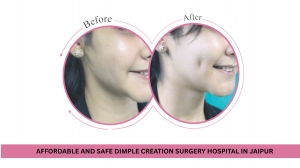 Affordable and Safe Dimple Creation Surgery Hospital in Jaipur