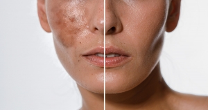 Reveal Your Natural Glow with Advanced Skin Whitening Treatment in Islamabad