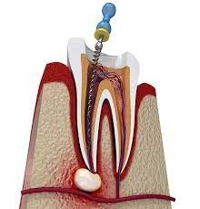 Understanding Root Canal Treatment in India: A Complete Guide for Patients