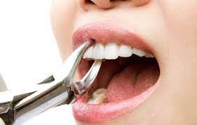 How Do I Prepare for a Tooth Removal Appointment?