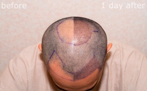 Hair Transplant in the UK