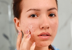 How Acne Treatment Dubai Improves Skin Health?
