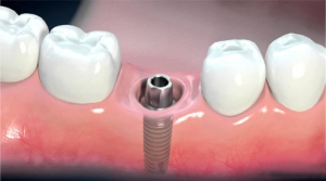 6 Facts About Dental Implants