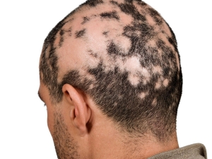 What Alopecia Areata Treatment Do Experts Suggest
