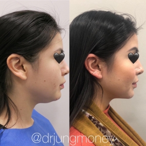 How Should You Prepare for Vaser Liposuction Surgery?