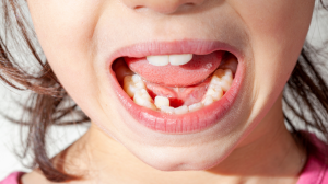 Crowded Teeth: Causes, Risks, and Modern Options for Correction