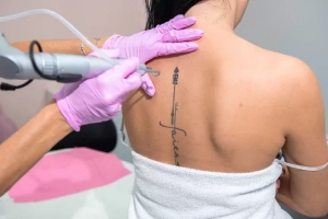 Is Laser Tattoo Removal Risky? Understanding the Risks and Side Effects