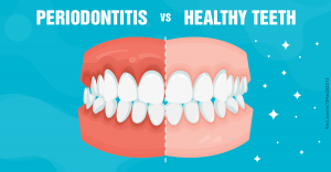 Gum Disease Cure - Complete Guide for Treatment and Prevention