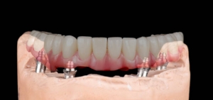 All-on-4 Dental Implants: A Full-Arch Solution for Missing Teeth