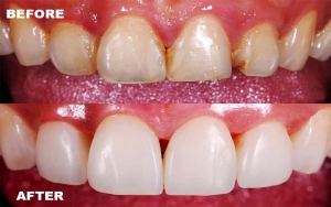 Is Dental Filling in Islamabad the Right Choice to Save Your Teeth and Restore a Confident Smile?