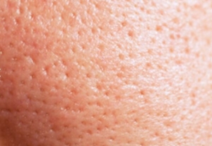 What Causes Open Pores?