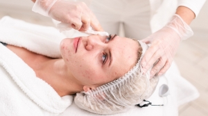 What Age Is Ideal for Acne Treatment Dubai?