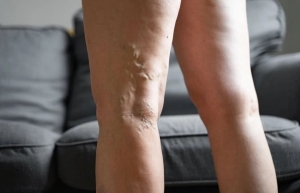 6 Most Efficient Varicose Vein Treatments