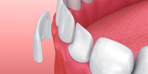 Are Veneers Stronger Than Teeth