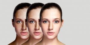 Effective Pigmentation Treatment in Delhi – Say Goodbye to Dark Spots