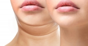 Surgery to Remove Double Chin: Helpful Explanation
