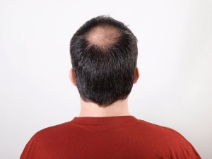 How Soon Will Hair Grow After Crown Hair Transplant?