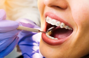 Transforming Smiles with Precision: What to Expect from an Orthodontist in Cupertino