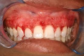 How Much Does Gum Depigmentation Cost?