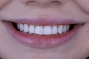 How to Choose the Right Dentist for Veneers
