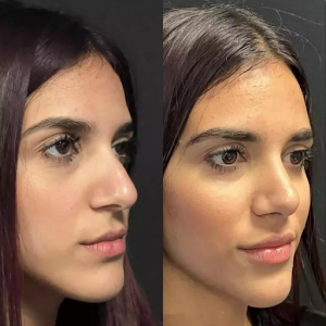 Best Septoplasty Surgeon in Dubai: Improve Breathing and Lifestyle