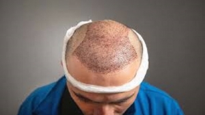 The Success Rate of Hair Transplant in Riyadh Clinics