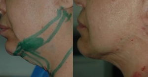 Neck Liposuction Before and After Images